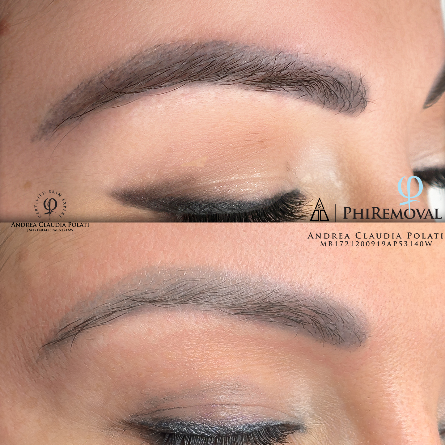 Rimozione tatuaggi con metodo innovativo